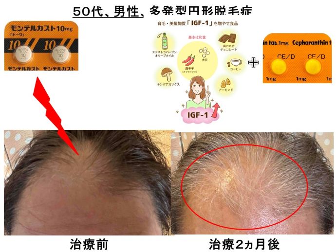 円形脱毛症　病院
